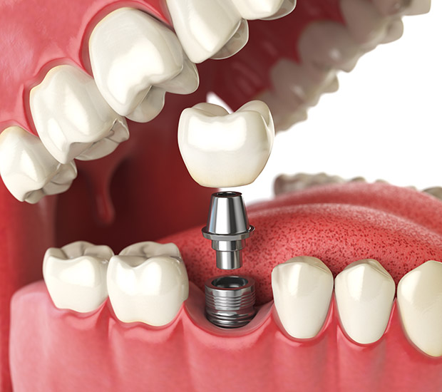 Scottsdale Will I Need a Bone Graft for Dental Implants