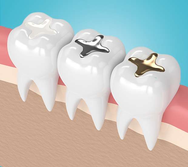 Scottsdale Composite Fillings