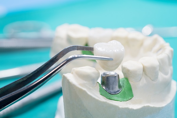 Who Should Consider Getting Dental Crowns?