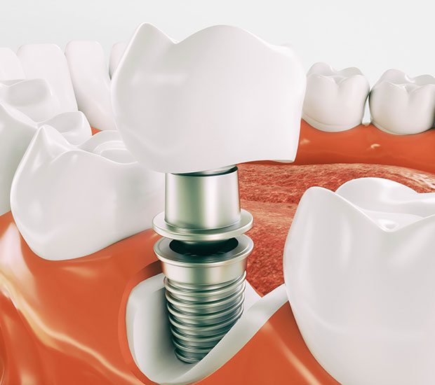 Scottsdale Dental Implant Restoration