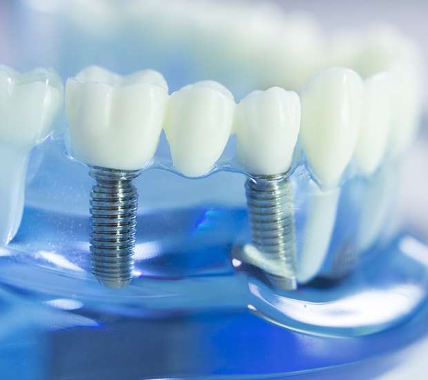 Scottsdale Dental Implants