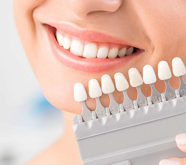 Scottsdale Dental Veneers and Dental Laminates