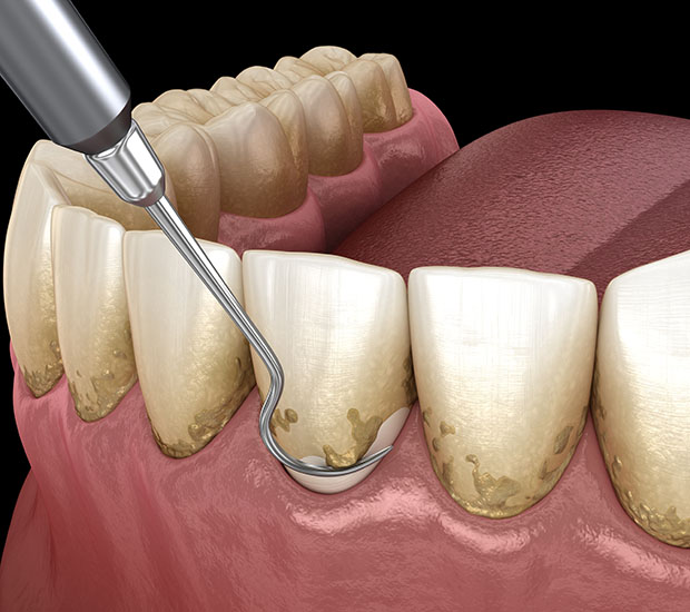 Scottsdale Root Scaling and Planing