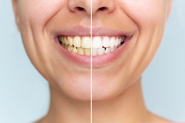 Take Home Teeth Whitening Trays Vs Over The Counter Whitening Products