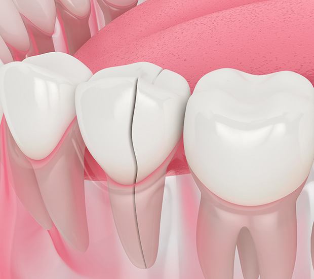 Scottsdale Types of Dental Root Fractures