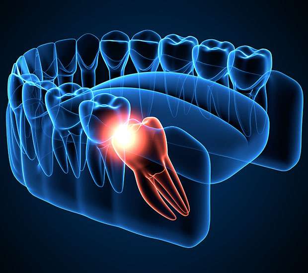 Scottsdale Wisdom Teeth Extraction