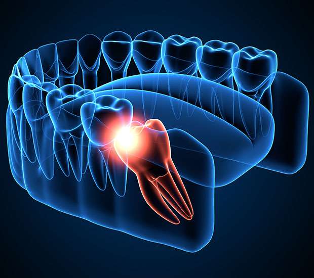 Scottsdale Wisdom Teeth Extraction